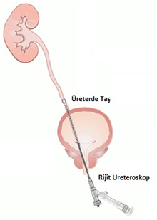 ÜRETEROSKOP İLE LAZER TAŞ CERRAHİSİ