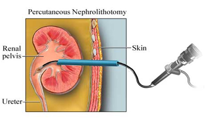 PERKÜTAN NEFROLİTOTOMİ (PCNL)